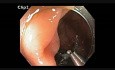 Kolonoskopia: endoskopowa resekcja śluzówkowa w obrębie kątnicy u pacjenta po operacji okrężnicy i wątroby