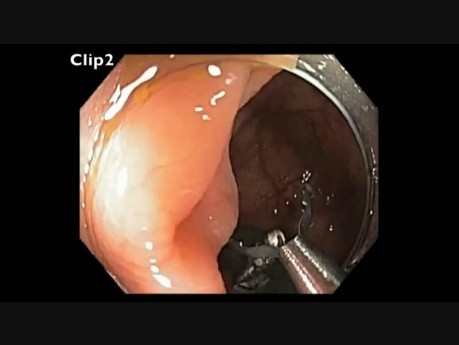 Kolonoskopia: endoskopowa resekcja śluzówkowa w obrębie kątnicy u pacjenta po operacji okrężnicy i wątroby