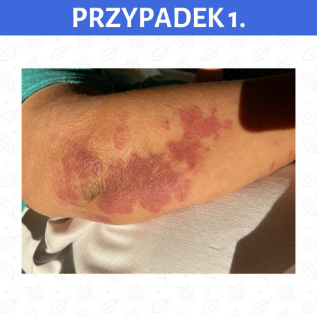 Przypadek kliniczny 1