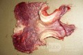 Obraz endoskopowy raka włóknistego żołądka obejmującego dno, trzon i część przedodźwiernikową (43 z 47)