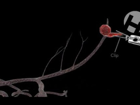 Tętniak mózgu - pawidłowe odcięcie