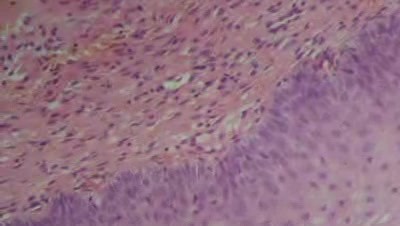Kanał szyjki macicy - Badanie histopatologiczne