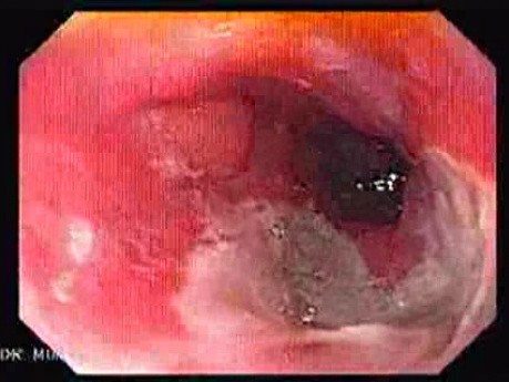 Uchyłek Rzekomy Przełyku - Ezofagoskopia