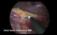 Operacja Hartmanna metodą laparoskopową