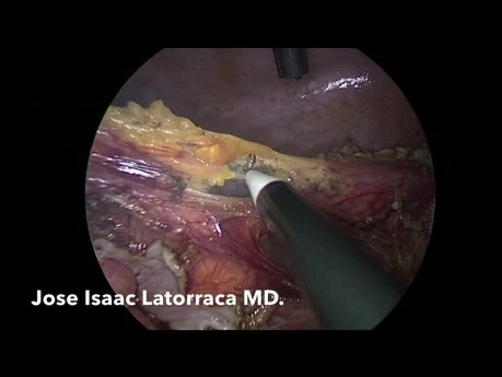 Operacja Hartmanna metodą laparoskopową