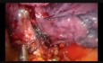 Wideotorakoskopowa lewa dolna lobektomia z jednego cięcia podżebrowego w technice fissureless
