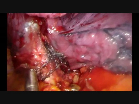 Wideotorakoskopowa lewa dolna lobektomia z jednego cięcia podżebrowego w technice fissureless