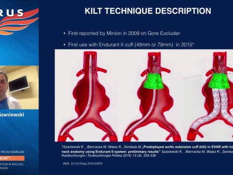 Kilt Technique in Hostile Neck AAA Supported with Endoanchors - a Technique Details and Case Report