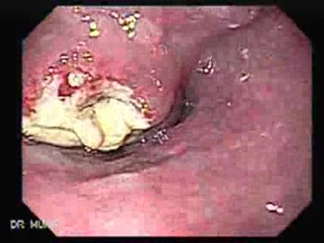 Drobnokomórkowy rak płuc atakuje górną i środkową część przełyku - widok ze strony górnego zwieracza przełyku