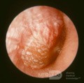 Ciężkie ostre zapalenie ucha środkowego 