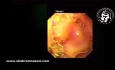 Endoscopie pour une Volumineuse Hernie Hiatale par Glissement avec Estomac Intrathoracique