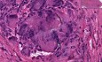 Reakcja na ciało obce - histopatologia - tkanka miękka