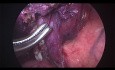 Wideotorakoskopowe anatomiczne usunięcie segmentu płuca. 