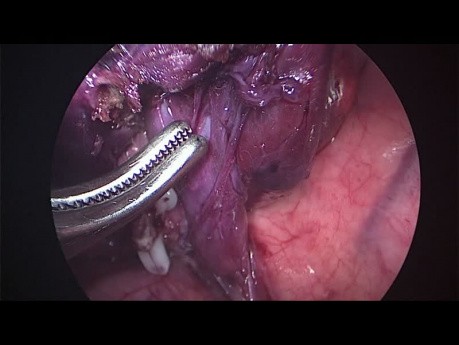 Wideotorakoskopowe anatomiczne usunięcie segmentu płuca. 