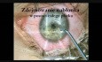 Laserowa korekcja wzroku techniką PRK i LASEK