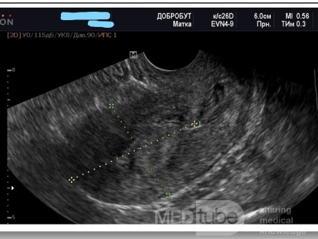 Hiperplazja endometrium podczas histeroskopii pod kontrolą USG