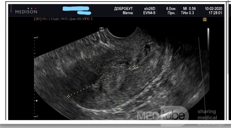 Hiperplazja endometrium podczas histeroskopii pod kontrolą USG
