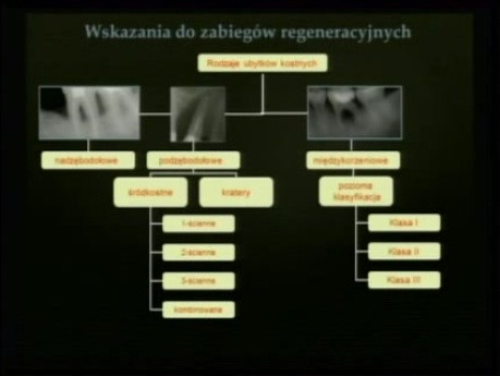 Skojarzone leczenie orto-perio-implantologiczne. Doświadczenia własne - część 3