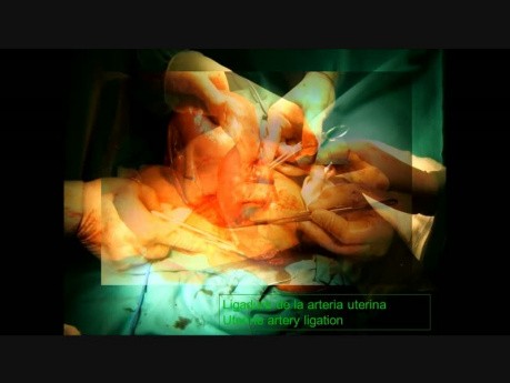 Podwiązanie tętnicy macicznej podczas cięcia cesarskiego