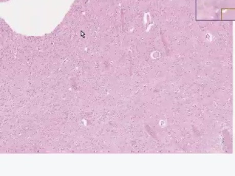 Glejak wielopostaciowy - histopatologia - mózg