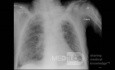 RTG klatki piersiowej - COVID-19 (3)