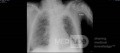 RTG klatki piersiowej - COVID-19 (3)