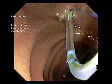 Mała brodawka / sfinkterotomia / ECPW
