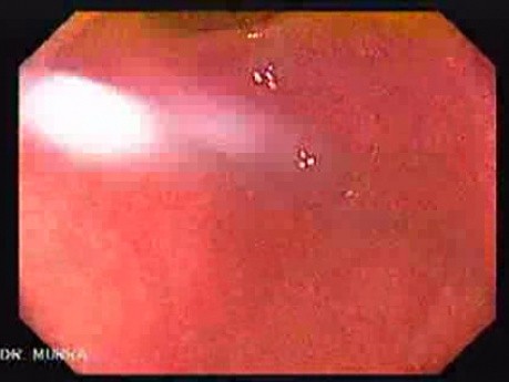 Odźwiernik oraz jama żołądka - wideoendoskopia wysokiej rozdzielczości (8 z 8)