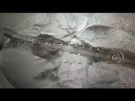 Postępowanie z nieudanym zabiegiem TEVAR z wyciekiem kontrastu i konwersją