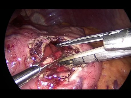 Operacja Jurasza techniką laparoskopową z powodu torbieli pozapalnej trzustki