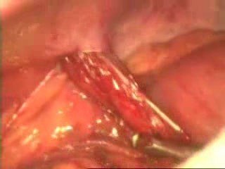Laparoskopia z powodu urazu penetrującego do jamy brzusznej z wytrzewieniem