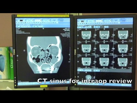 Operacja endoskopowa zatok przynosowych (FESS) - wstęp dla chirurgów