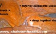 Landmarks for Laparoscopic Hernia Repair