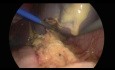 Splenektomia laparoskopowa
