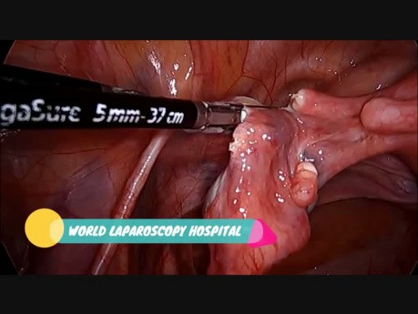 Całkowita laparoskopowa histerektomia przy zastososowaniu pęcherzowego cewnika podczerwonego