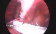 Operacja przepukliny pachwinowej - metoda laparoskopowa