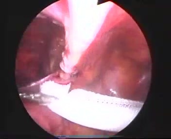 Operacja przepukliny pachwinowej - metoda laparoskopowa