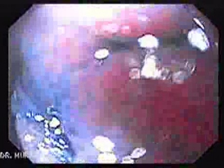Wrzód przedodźwiernikowy - endoskopia (6 z 9)