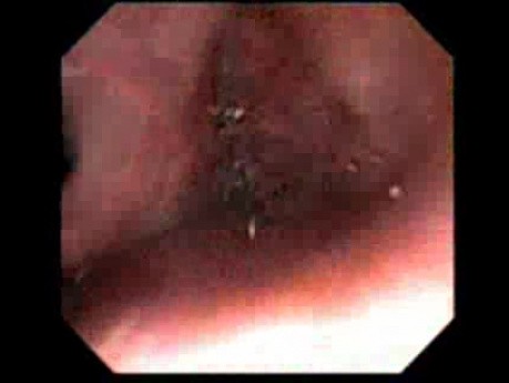 Manewr Retrofleksyjny Poza Ciałem Pacjenta - Obraz Endoskopowy Jamy Nosowej 
