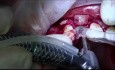 Wszczepienie implantów 12 i 22 z zastosowaniem sterowanej regeneracji kości (GBR)