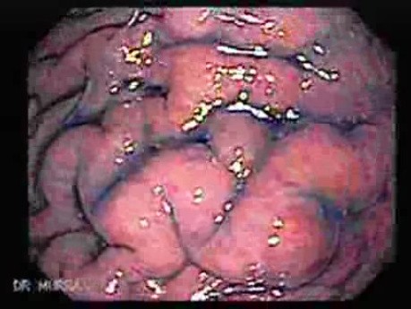 Rak włóknisty żołądka - endoskopia (3 z 15)