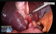 Bezpieczna metoda wykonywania cholecystektomii laparoskopowej