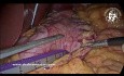 Rękawowa resekcja żołądka w przypadku pneumatozy jelit