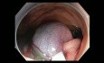 Komplikacje mukozektomii endoskopowej (EMR) - krwawienie z wstępnicy - przypadek 1A