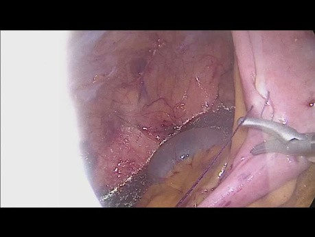 Zespolenie intrakorporalne w laparoskopowej prawej hemikolektomii