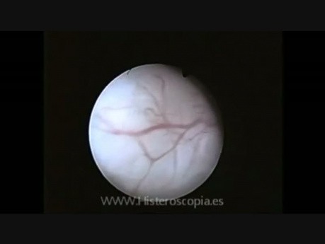 Polip endometrialny w obrazie USG i histeroskopii