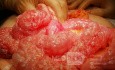 Pneumatoza jelit (Pneumatosis cystoides intestinalis)