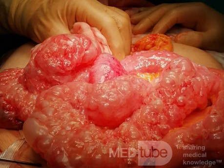 Pneumatoza jelit (Pneumatosis cystoides intestinalis)