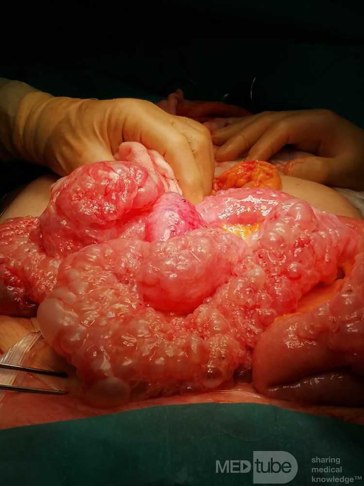 Pneumatoza jelit (Pneumatosis cystoides intestinalis)