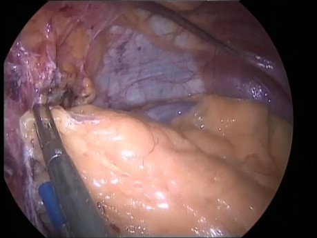 Omentoplastyka z użyciem nebulizowanego Glubranu 2 w rękawowej resekcji żołądka